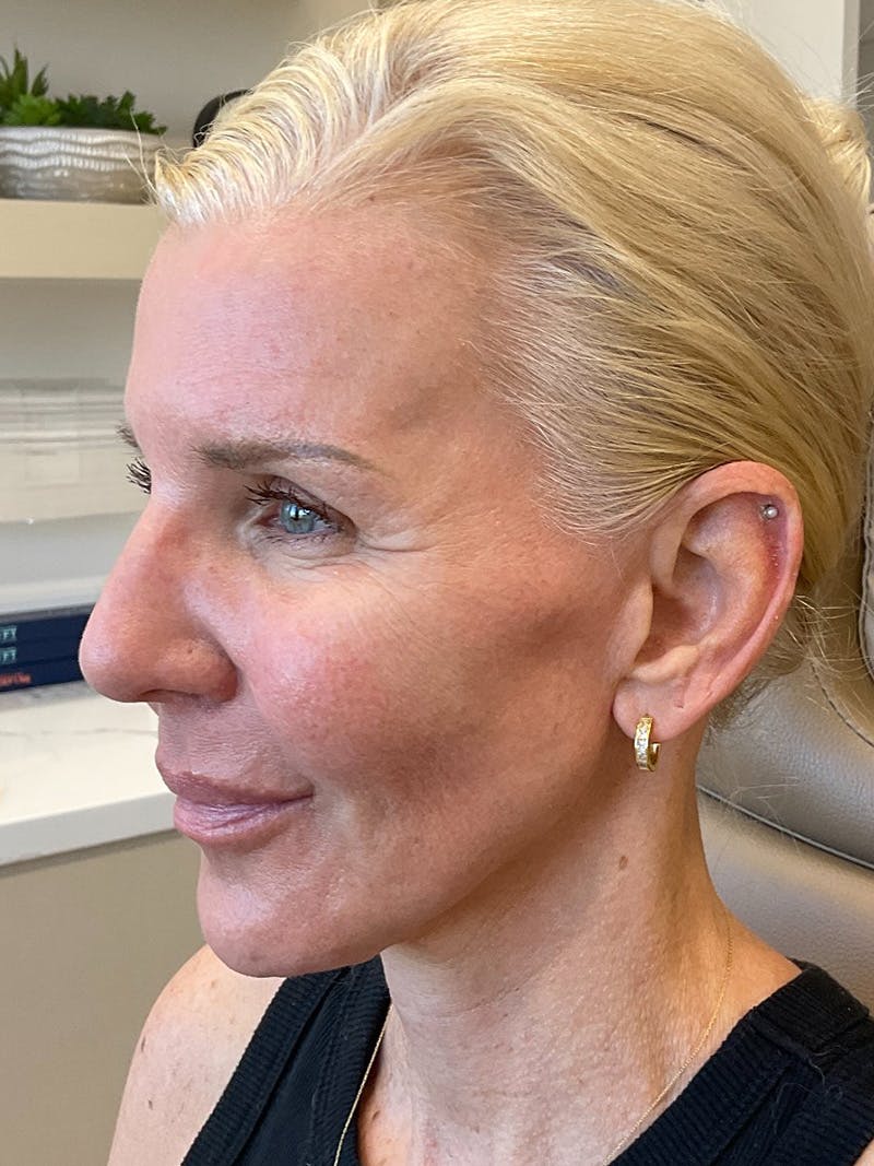 Jawline Contouring Before & After Gallery - Patient 292566 - Image 3