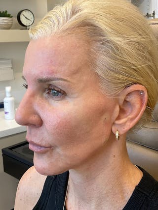 Jawline Contouring Before & After Gallery - Patient 292566 - Image 4