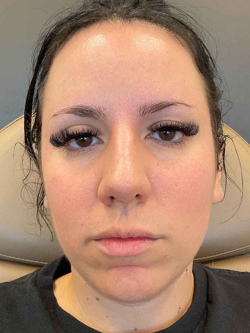 Lip Filler Before & After Gallery - Patient 152882 - Image 1