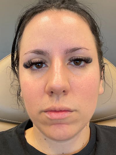 Chin Filler Before & After Gallery - Patient 333549 - Image 1