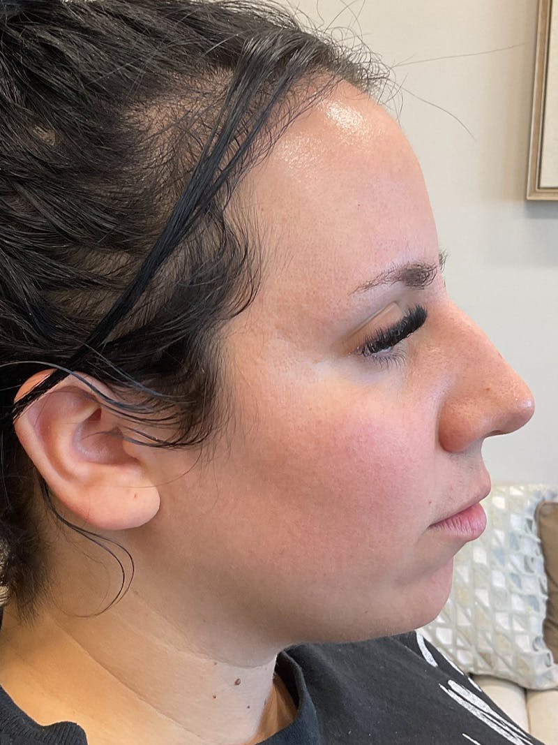 Lip Filler Before & After Gallery - Patient 152882 - Image 3
