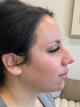 Chin Filler Before & After Gallery - Patient 333549 - Image 4