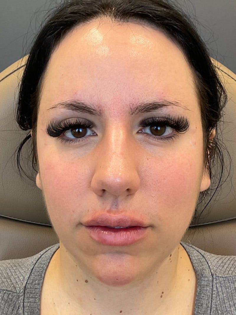 Lip Filler Before & After Gallery - Patient 152882 - Image 2