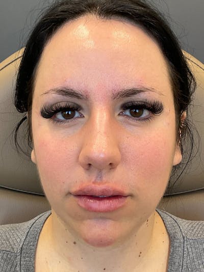 Chin Filler Before & After Gallery - Patient 333549 - Image 2