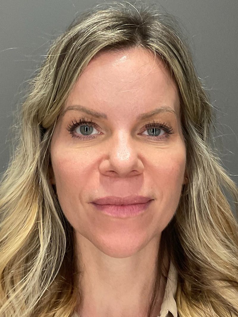 Natural Growth Factor Injections Before & After Gallery - Patient 265557 - Image 1