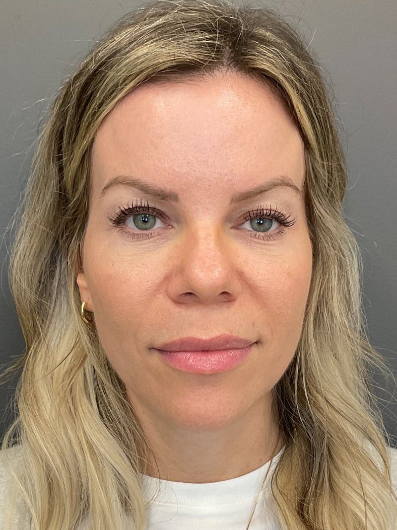 Natural Growth Factor Injections Before & After Gallery - Patient 265557 - Image 2