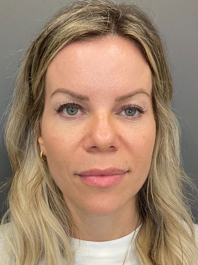 Tear Trough Before & After Gallery - Patient 282787 - Image 2