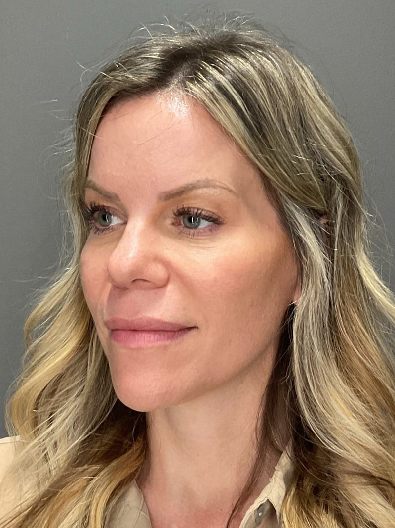 Natural Growth Factor Injections Before & After Gallery - Patient 265557 - Image 5