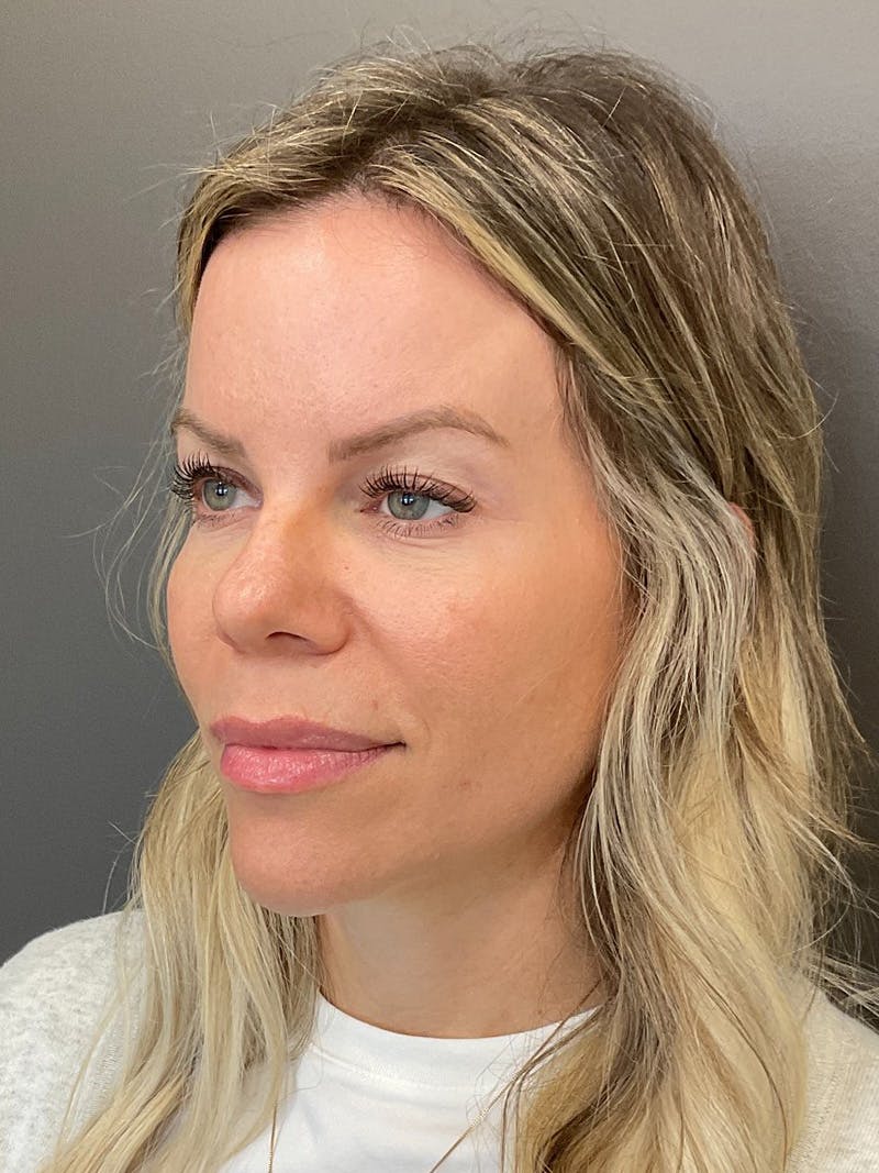 Natural Growth Factor Injections Before & After Gallery - Patient 265557 - Image 6
