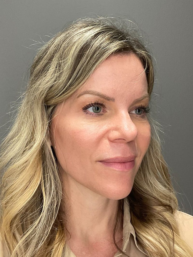 Natural Growth Factor Injections Before & After Gallery - Patient 265557 - Image 3
