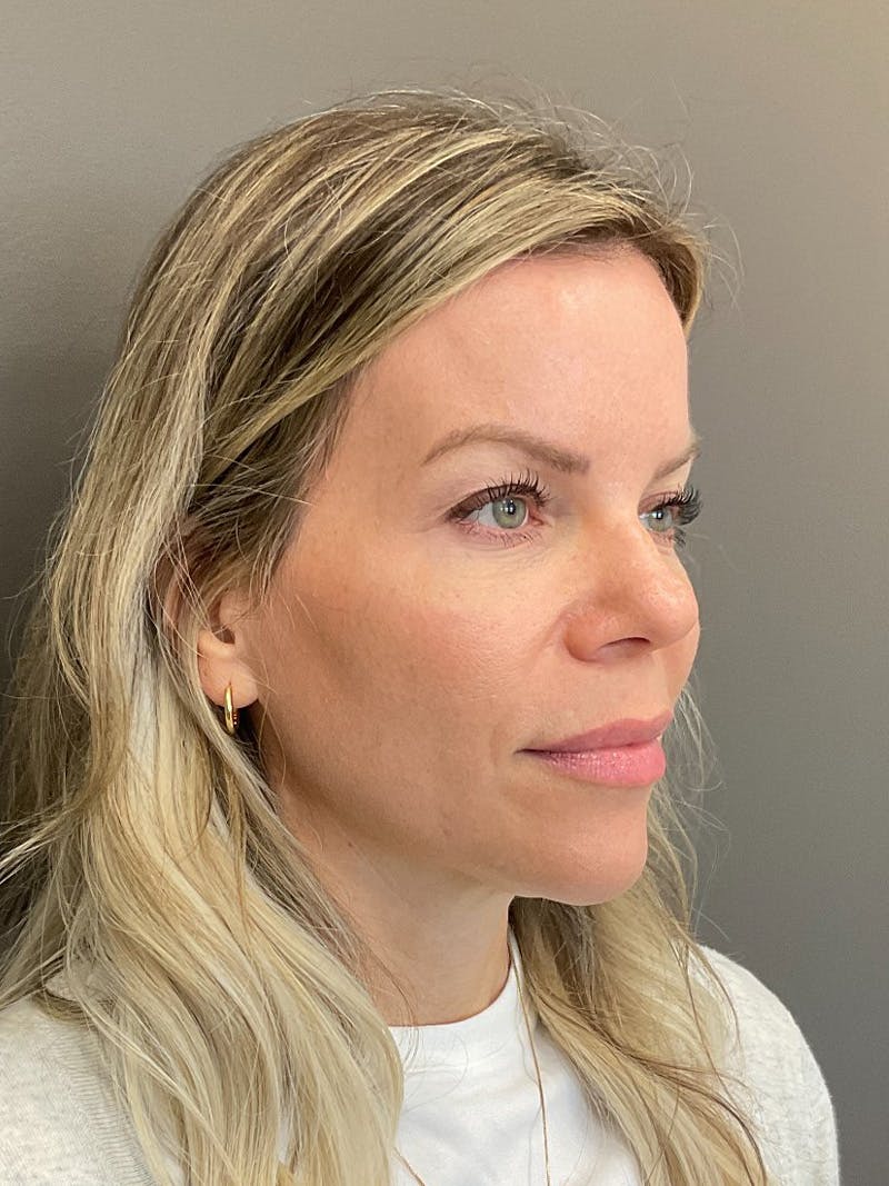 Natural Growth Factor Injections Before & After Gallery - Patient 265557 - Image 4