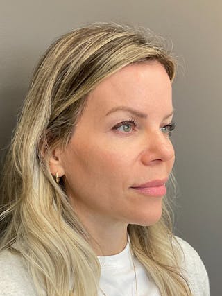Natural Growth Factor Injections Before & After Gallery - Patient 265557 - Image 4