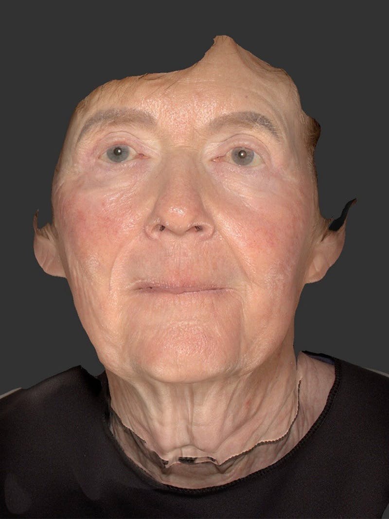 Laser Treatment Before & After Gallery - Patient 797335 - Image 1