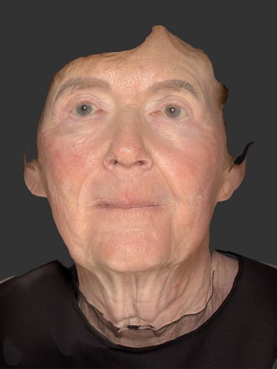 Laser Treatment Before & After Gallery - Patient 797335 - Image 1