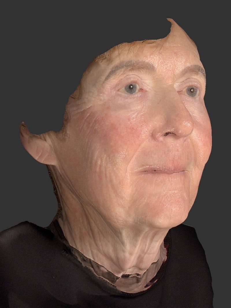Laser Treatment Before & After Gallery - Patient 797335 - Image 3