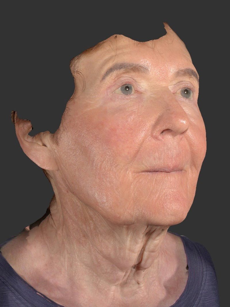 Laser Treatment Before & After Gallery - Patient 797335 - Image 4