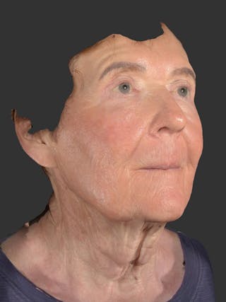 Laser Treatment Before & After Gallery - Patient 797335 - Image 4