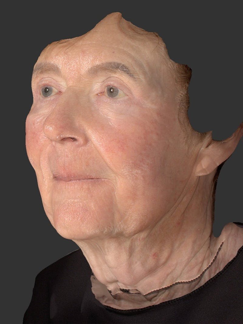 Laser Treatment Before & After Gallery - Patient 797335 - Image 5