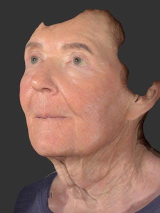 Laser Treatment Before & After Gallery - Patient 797335 - Image 6