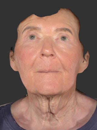 Laser Treatment Before & After Gallery - Patient 797335 - Image 2