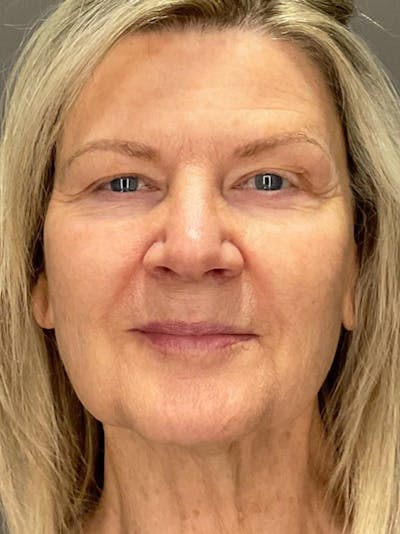 Laser Treatment Before & After Gallery - Patient 292579 - Image 1