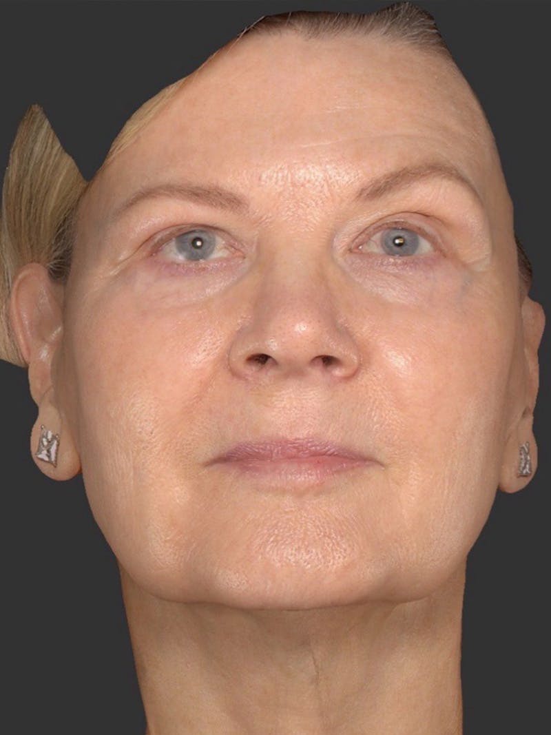 Microneedling Treatment Before & After Gallery - Patient 199581 - Image 2