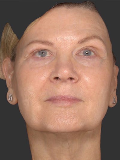 Laser Treatment Before & After Gallery - Patient 292579 - Image 2