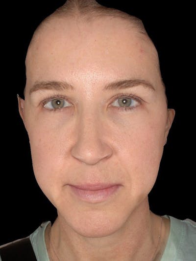 Microneedling Treatment Before & After Gallery - Patient 200273 - Image 1