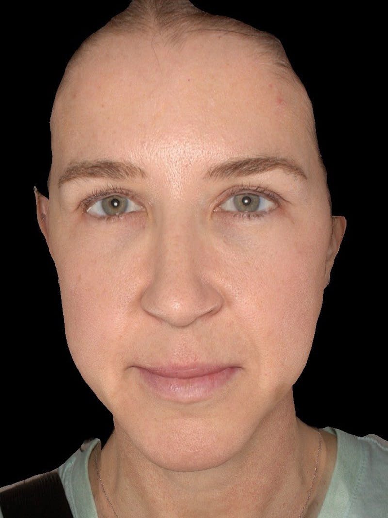 Microneedling Treatment Before & After Gallery - Patient 200273 - Image 1