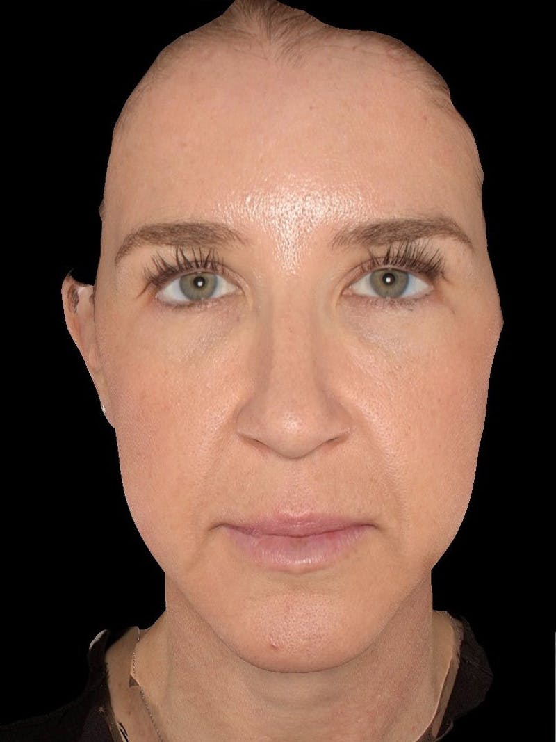 Microneedling Treatment Before & After Gallery - Patient 200273 - Image 2