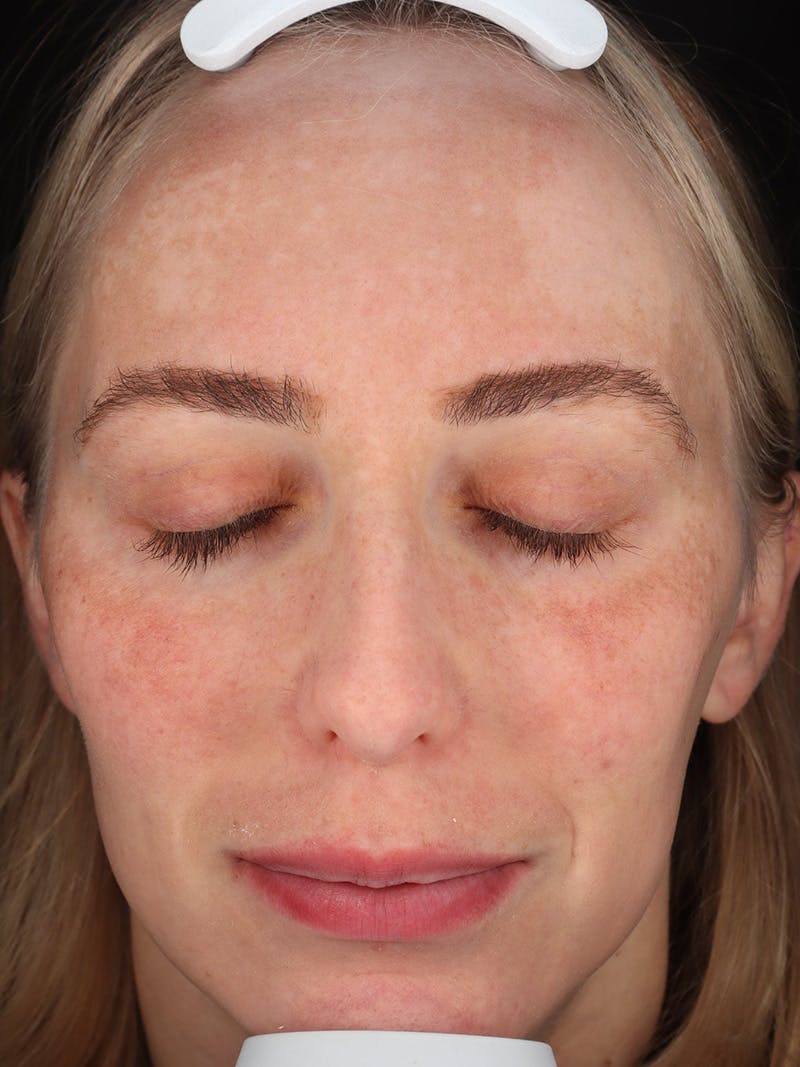Skin Care Protocol Before & After Gallery - Patient 410294 - Image 1