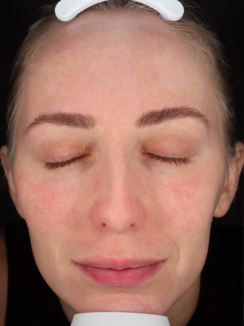 Skin Care Protocol Before & After Gallery - Patient 410294 - Image 2