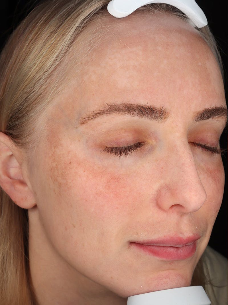 Skin Care Protocol Before & After Gallery - Patient 410294 - Image 3