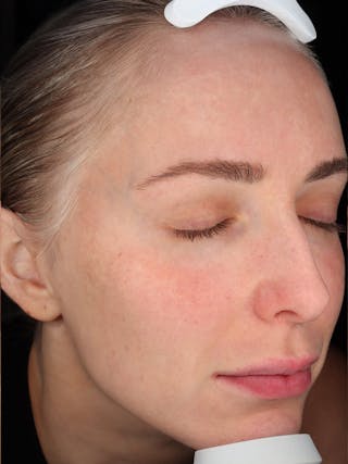 Skin Care Protocol Before & After Gallery - Patient 410294 - Image 4