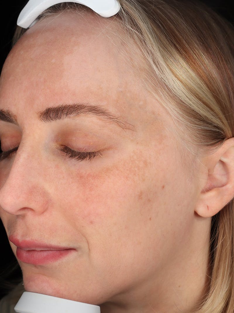 Skin Care Protocol Before & After Gallery - Patient 410294 - Image 5