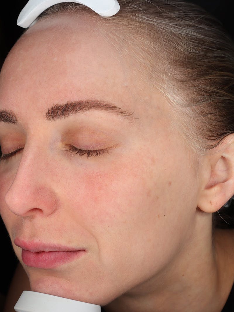 Skin Care Protocol Before & After Gallery - Patient 410294 - Image 6