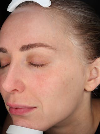 Skin Care Protocol Before & After Gallery - Patient 410294 - Image 6