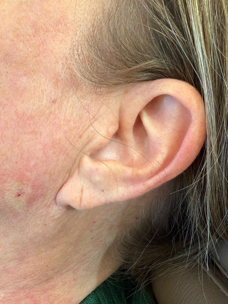 Earlobe Repair Before & After Gallery - Patient 192467 - Image 3