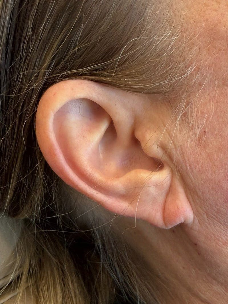 Earlobe Repair Before & After Gallery - Patient 192467 - Image 1