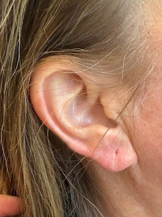 Earlobe Repair Before & After Gallery - Patient 192467 - Image 2