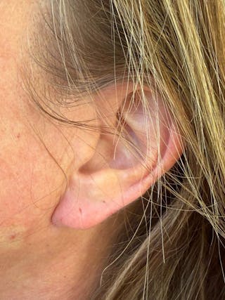Earlobe Repair Before & After Gallery - Patient 192467 - Image 4