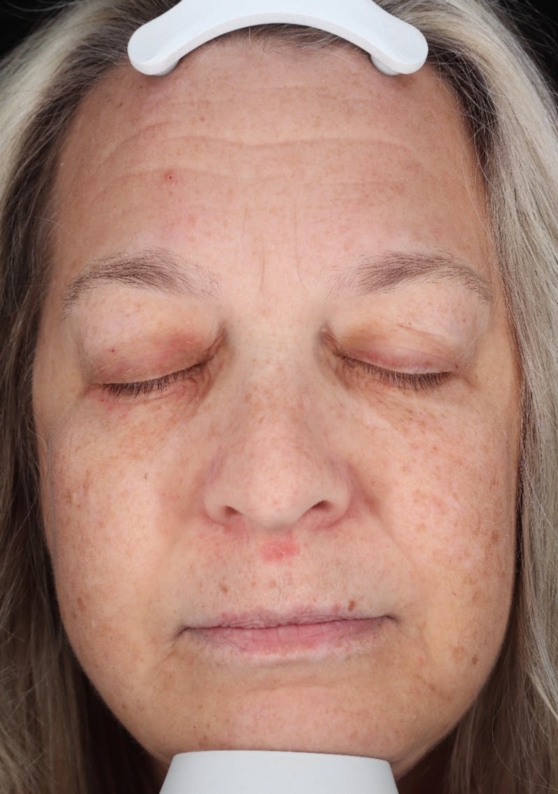 Botox/Dysport Before & After Gallery - Patient 318055 - Image 1