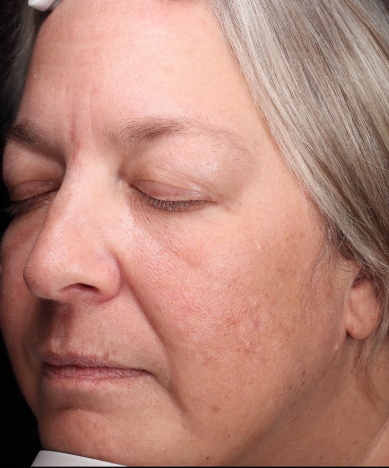 Botox/Dysport Before & After Gallery - Patient 318055 - Image 6