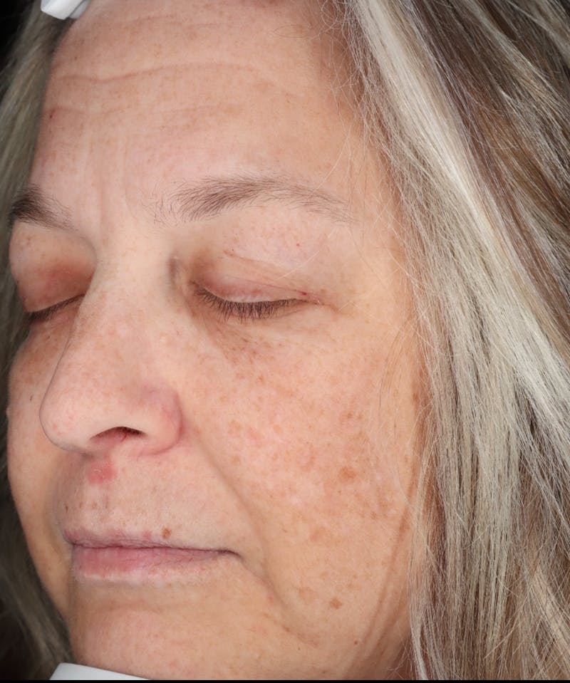 Botox/Dysport Before & After Gallery - Patient 318055 - Image 5