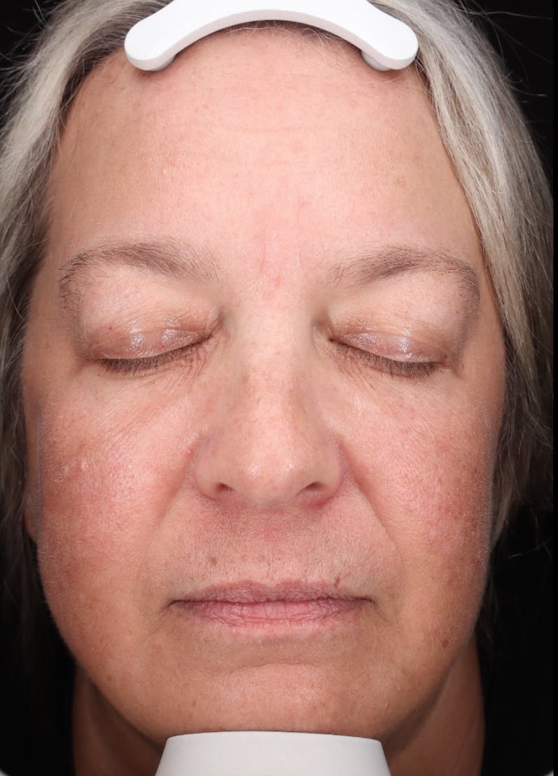 Botox/Dysport Before & After Gallery - Patient 318055 - Image 2