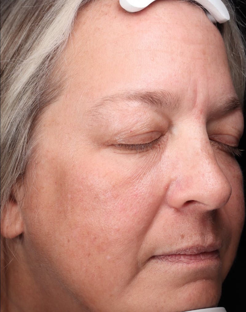 Botox/Dysport Before & After Gallery - Patient 318055 - Image 4