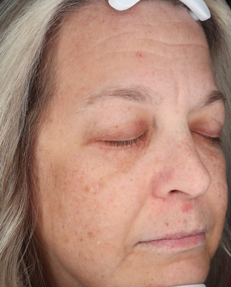 Botox/Dysport Before & After Gallery - Patient 318055 - Image 3