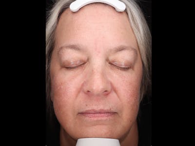 Botox/Dysport Before & After Gallery - Patient 318055 - Image 2