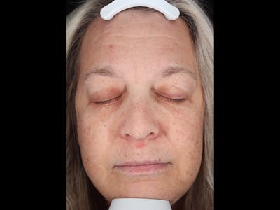 Botox/Dysport Before & After Gallery - Patient 318055 - Image 1