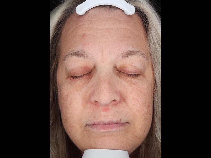 Chemical Peel Before & After Gallery - Patient 367541 - Image 1
